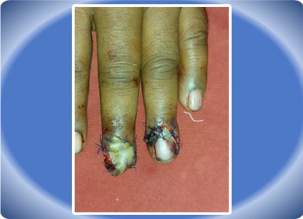 FINGER INJURY
